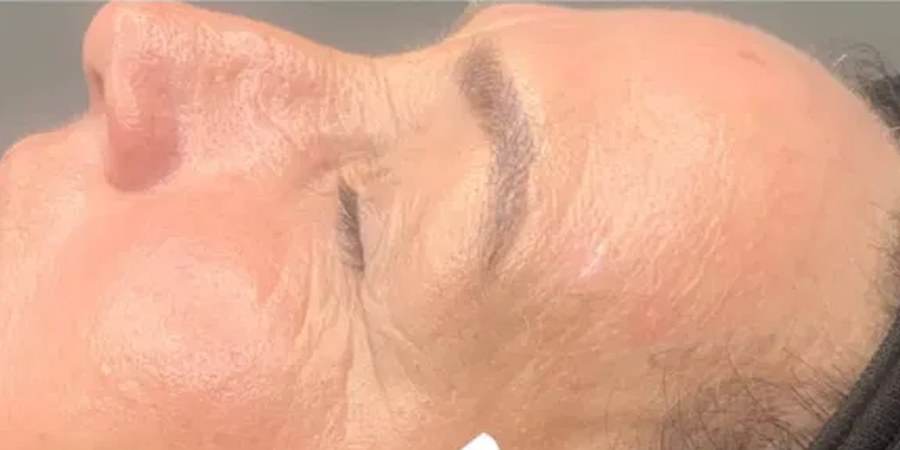 Microneedling – Nachher