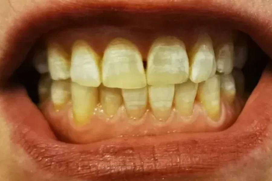 Teeth Whitening – Vorher