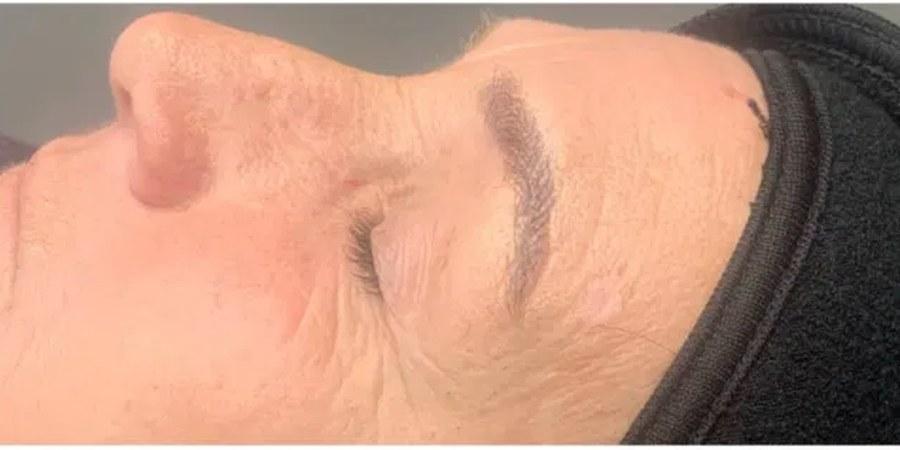 Microneedling – Vorher