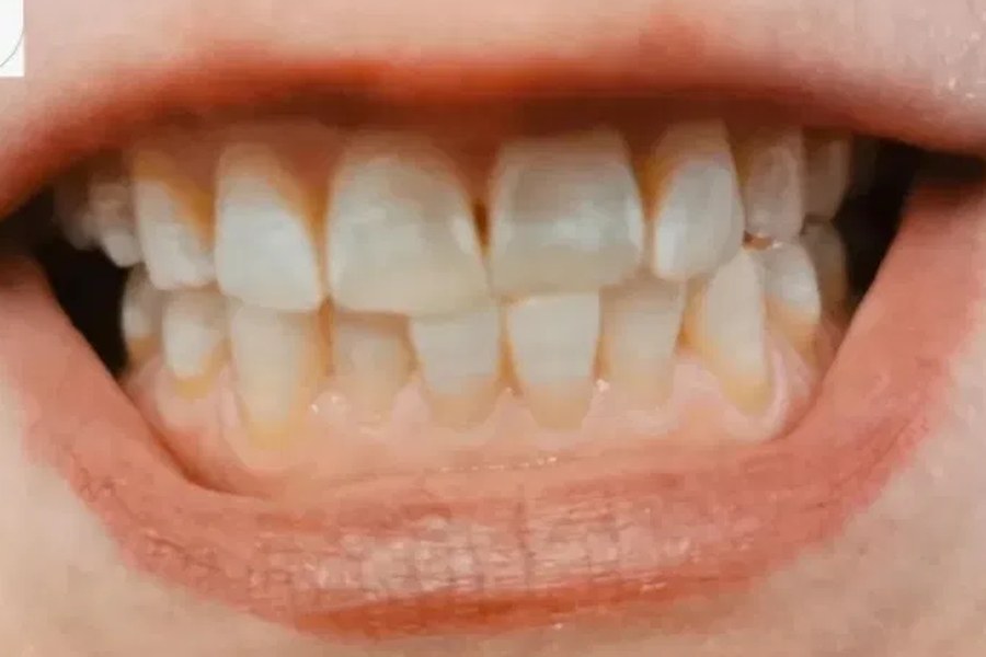 Teeth Whitening – Nachher