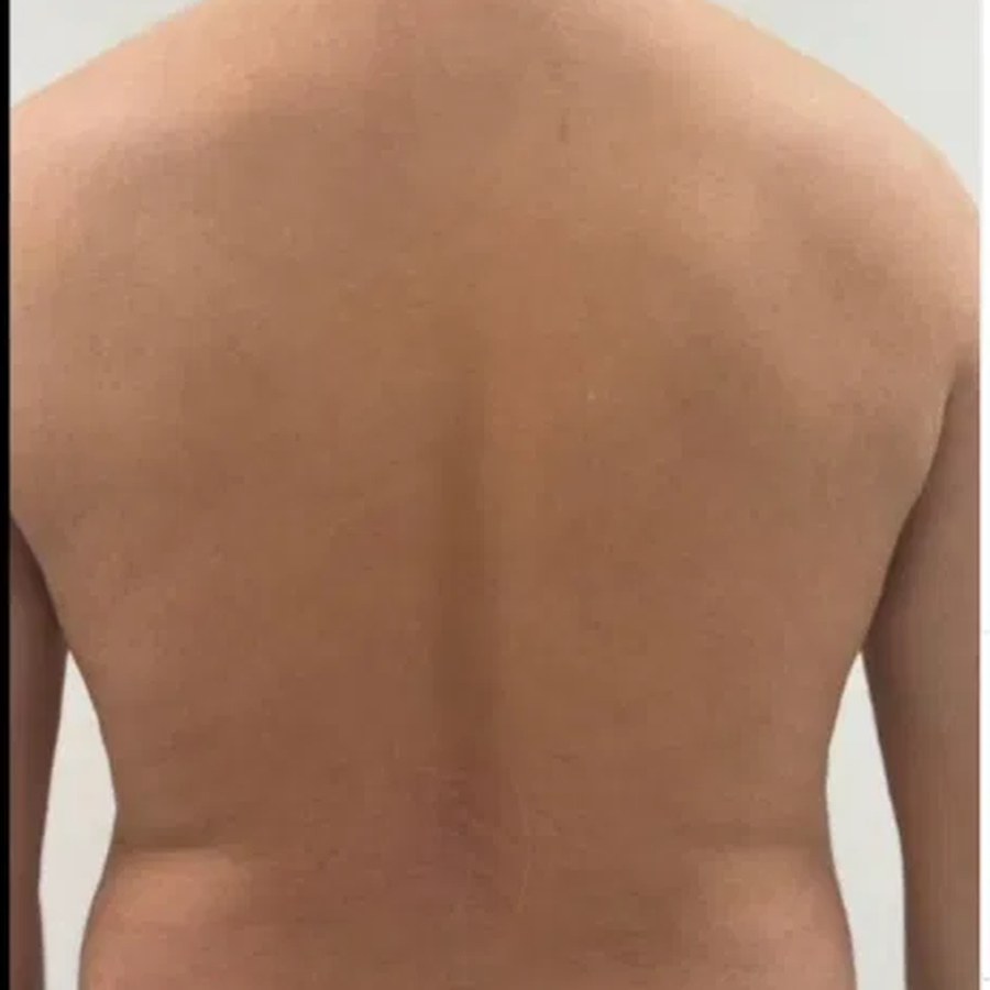 ICE Diodenlaser – Nachher