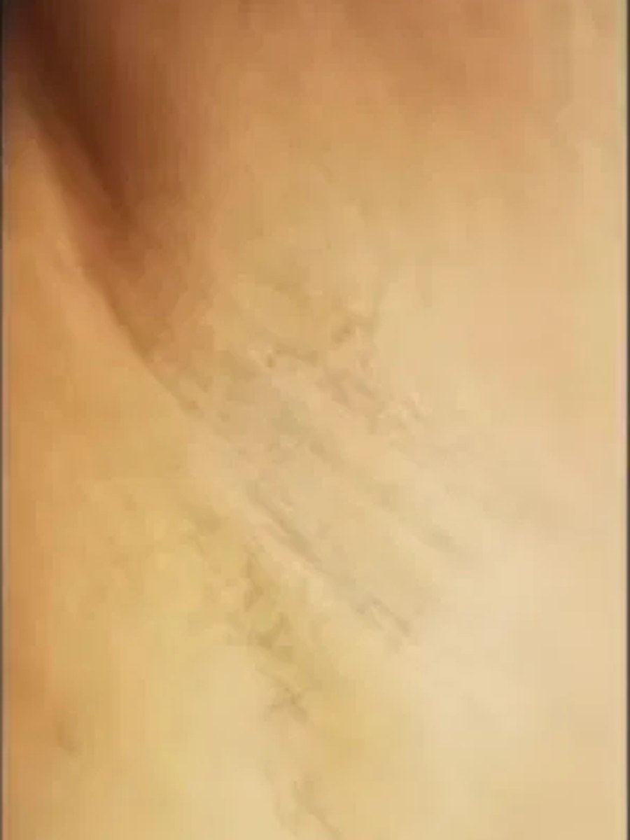 ICE Diodenlaser Haarentfernung – Nachher